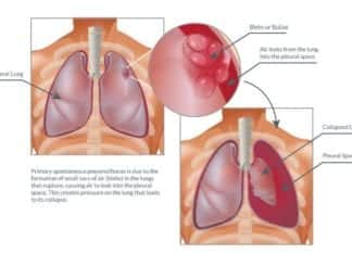 Spontaneous Pneumothorax